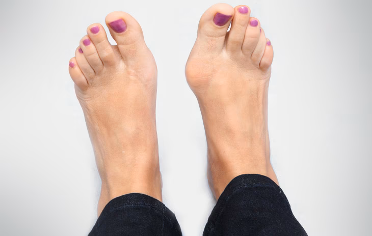 Co wolno po operacji haluksa?